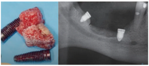 Xenograft rejection resulted in additional bone loss. Short implants were placed on defect margins for rehabilitation.