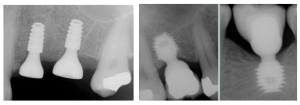 Short dental implants placed subcrestally so entire implant body has dense bone support as 0. 8-1. 2mm bone loss occurs in a year.