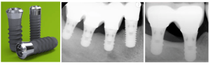 Transgingival implant design reaching the margin is a solution to avoid subcrestal bone loss with short dental implants.