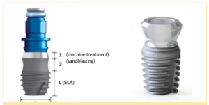 Studies show minimal issues with short dental implants designed for transgingival placement at the margin.