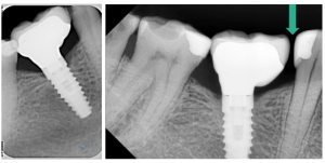 Why gaps appear between teeth and implants screenshot 62