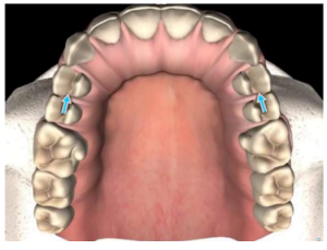 Why gaps appear between teeth and implants screenshot 64