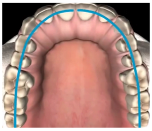 Why gaps appear between teeth and implants screenshot 65