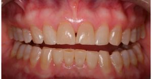 Why gaps appear between teeth and implants screenshot 67