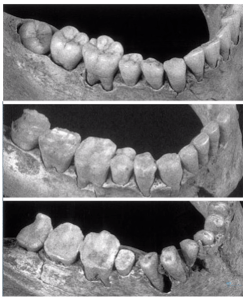Why gaps appear between teeth and implants screenshot 75