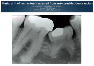 Why gaps appear between teeth and implants screenshot 77