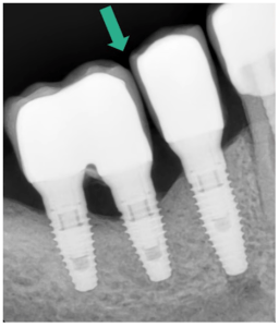 Why gaps appear between teeth and implants screenshot 78