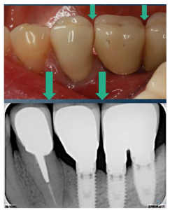 Why gaps appear between teeth and implants screenshot 79