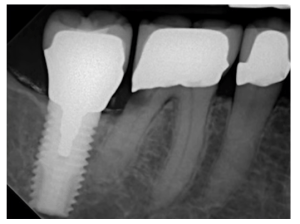 Why gaps appear between teeth and implants screenshot 81