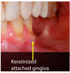 The patient displays partial adentia and significant gum recession on the outermost teeth, yet there is a strip of keratinized gingiva attached, suggesting the body's effort to preserve soft tissue structure despite challenging conditions.