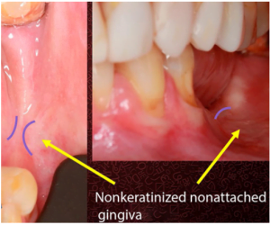 Significant dissolution of the keratinized gingiva, with only a faint strip of keratinized tissue remaining and the surrounding area showing mobile mucosa.