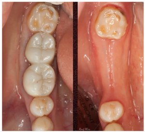 The process of a tooth being extracted, leading to the subsequent detachment of the periodontal ligaments and the subsequent rebuilding of the complex soft tissue functioning.