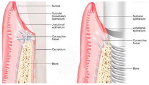 A comparison is shown between the gingival attachment of a living tooth and a root implant, where both demonstrate a similar anatomical and structural attachment with a gingival cuff.