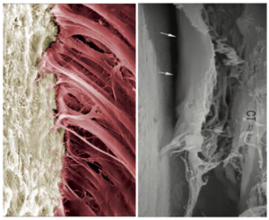 A comparison between a live tooth with strong collagen fiber connection to its root cement and an implant with collagen fibers that can easily peel off and detach from the implant surface.