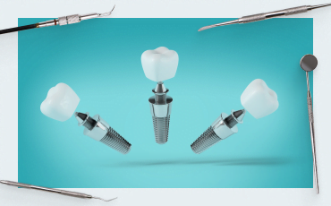 The right way to choose a dental implant system