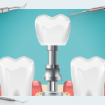 Why gaps appear between teeth and implants