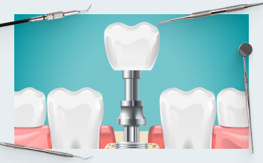 Why gaps appear between teeth and implants