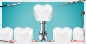Why gaps appear between teeth and implants blog post v4 3 big
