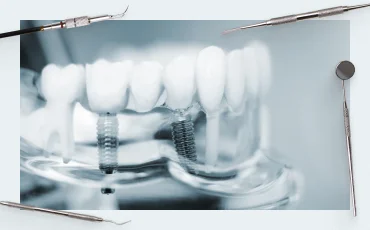 Differences between implants. How they differ from each other when it comes to shape