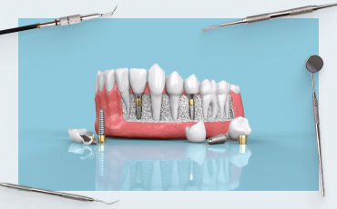 How long should a dental implant be?