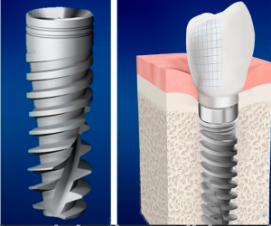 Differences between implants. How they differ from each other when it comes to shape screenshot 10