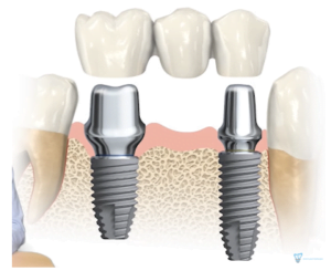 How long should a dental implant be? Screenshot 14