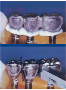 Which is better: single implants or bonded bridges on implants screenshot 25