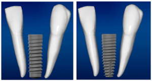 Differences between implants. How they differ from each other when it comes to shape screenshot 5