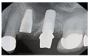 Differences between implants. How they differ from each other when it comes to shape screenshot 6