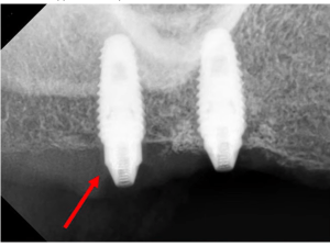 Successful-looking implant in scans, but after attaching the abutment and applying 30 ncm of force, the implant rotated.