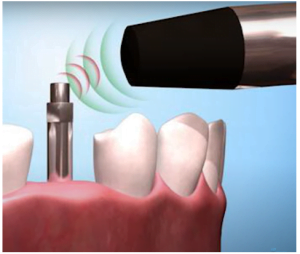 Magnetic resonance method being the final recommended option for checking the stability of the implant.