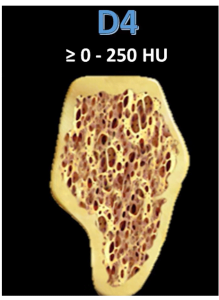 Structural characteristics of the d4 bone type, featuring a thin cortical plate and coarse-meshed trabeculae, highlighting its seriousness as a problem.