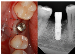The use of a high gingiva former inserted in an implant to strengthen the bone and the subsequent forces applied by the tongue, cheeks, and food clods causing changes in the surrounding bone structure.