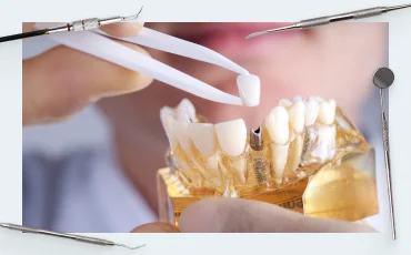How to check implant stability (whether the implant has “taken root”)
