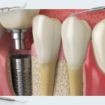 Soft tissue implant integration (part 2)