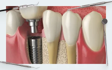 Soft tissue implant integration (part 2)