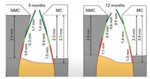 The comparison of bone gain and connective tissue growth between a rough implant and a classical implant over a 3 to 12-month period, showing a 0. 1 mm bone gain and a slight increase in connective tissue height for the rough implant.