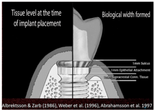 Tissue level at the time of implant placement