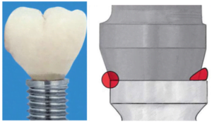 A comparison of two dental crowns, with the first photo depicting a crown on a smaller abutment displaying a distinct step on the interface line, and the second photo highlighting the difference in size at the interface, with a left-colored circle indicating the platform switching side where the step is visible.