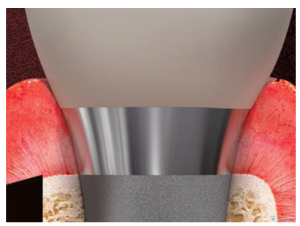 The implant design exhibits nearly perfect soft tissue integration.