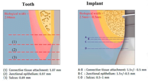 Implant with a neck height of 2. 8 mm, allowing for the formation of a complete complex of soft-tissue attachment, including connective tissue attachment, epithelial attachment, and sulcus