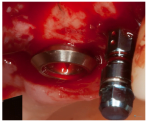 Freshly inserted dental implant, revealing the bone and oral epithelium layers, including the superficial part and basal membrane of the epithelium, illustrating the healing process and formation of the gingival cuff.
