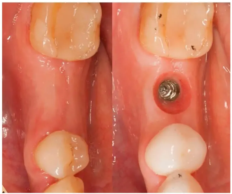 healing socket after tooth extraction