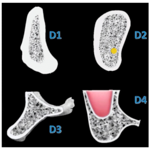 Bone density classification is general - d2 bone does not strictly define cortical thickness or cancellous structure. Bone has uneven and disproportionate distribution.