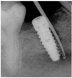 Torque or primary stability of the implant torque or primary stability of the implant 2