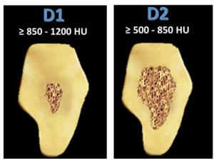 Diagram showing bone density values for classification d1 bone ranging from 850-1200 units or higher.