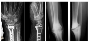 Fibrous tissue can impede bone healing without proper immobilization, as shown on right image.
