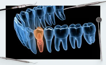 Torque or primary stability of the implant
