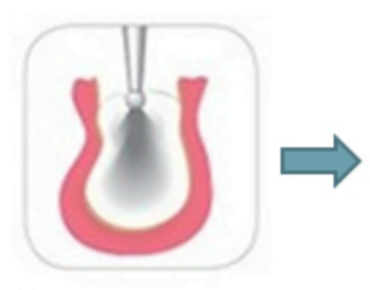 Description of the dental implant procedure description of the dental implant procedure 2