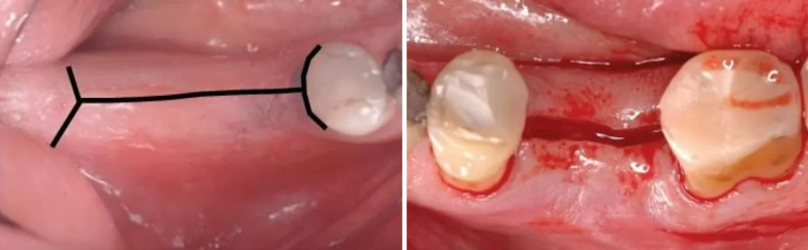 A crestal incision is made to access the alveolar ridge and elevation a flap, as shown. This simple approach is good for initial practice.